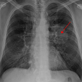 Lung cancer seen on a chest X-ray. Image by James Heilman, MD, at Wikimedia Commons. Licensed under CC BY-SA 3.0.