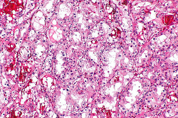 Clear cell renal cell carcinoma.  Image by Nephron, licensed under CC BY-SA 3.0 via Wikimedia.