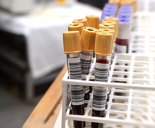 The idea of liquid biopsy for cancer diagnosis and treatment is gaining in popularity.