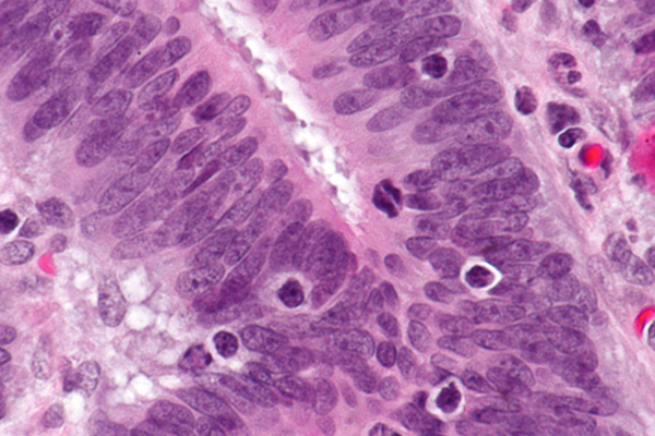 Micrograph showing tumor-infiltrating lymphocytes in a case of colorectal cancer with evidence of microsatillite instability-high on immunostaining.