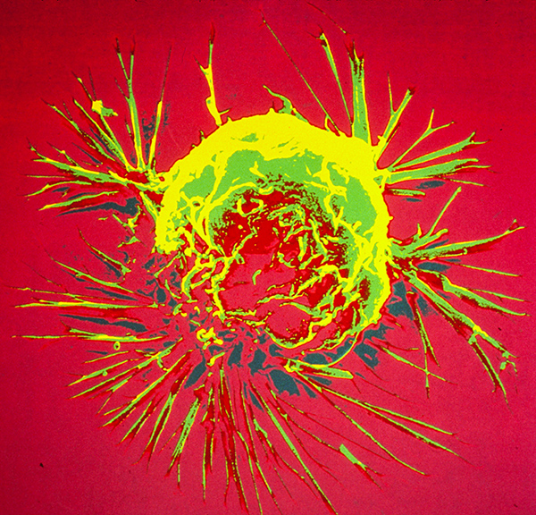 Breast cancer cell. Photo source: National Cancer Institute. 