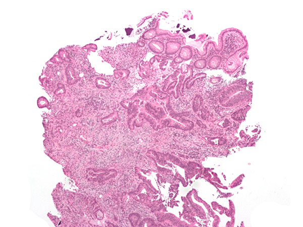 Invasive adenocarcinoma (the most common type of colorectal cancer). The cancerous cells are seen in the center and at the bottom right of the image (blue). Near normal colon-lining cells are seen at the top right of the image.