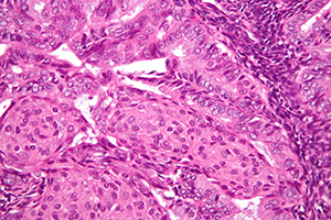 Very high magnification micrograph of endometrioid endometrial adenocarcinoma. H&E stain. Endometrioid endometrial adenocarcinoma is the most common form of endometrial cancer.