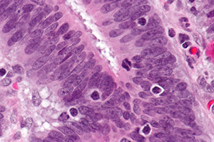 Micrograph showing tumor-infiltrating lymphocytes in a case of colorectal cancer with evidence of MSI-H on immunostaining.