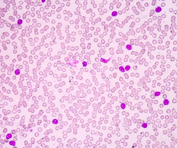 Chronic lymphocytic leukemia arises when the bone marrow makes too many lymphocytes.