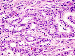 Histopathogic image of pancreatic adenocarcinoma arising in the pancreas head region. Source: Wikimedia Commons