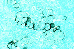Human tumor cells from the pancreas stained with an immunocytochemical stain with methyl green in the background and magnified to 400x. Source: Dr. Lance Liotta Laboratory, NCI.